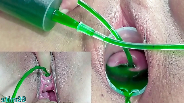 Japanese Lesbians Cervix and Pee Hole Inflation with Injections: Intimate Pleasures Unleashed